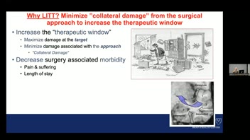 UCLA 101 Neurosurgery Series: Robert E. Gross, MD, PhD; Epilepsy Surgery