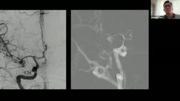 1st Latin American Grand Rounds-Part 2 Endovascular Treatment MCA Aneurysms; Dr. Giancarlo Saal Zapata MD; Johan Choque Velasquez MD, PhD., Organizer