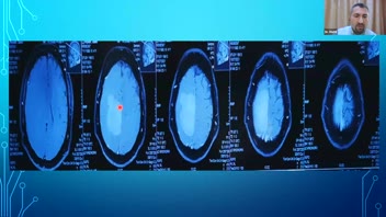 Intra operative Ultra sound in Neurosurgery; Neuro-oncology; Dr. Wameedth Matti;