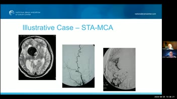 EC-IC Bypass for Cerebral Aneurysms, Skull base lesions; Eric Nussbaum, MD -Part 2