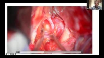Anterior Communicating Aneurysms-Case Video
