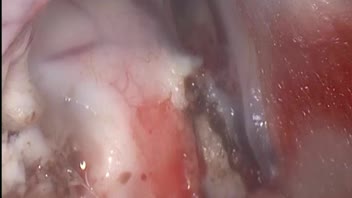 How I approach 3rd ventricle using an endoscopic transchoroidal route
