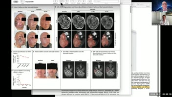 Molecular Treatment of Specific Genetic Cause of AVM; Guillaume Canaud , MD