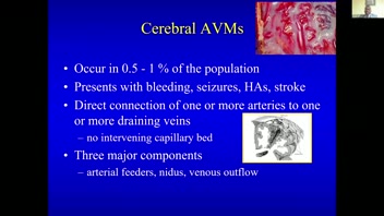 Management of ICH; AVM;  Cavernous Angioma; Cavernoma