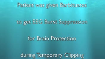 Giant R MCA Aneurysm; Dr. James Ausman; Direct surgery; 2012